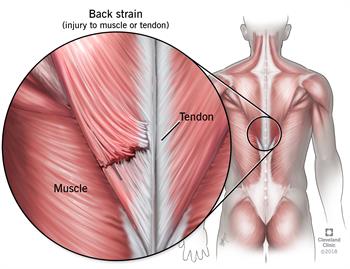 back strain